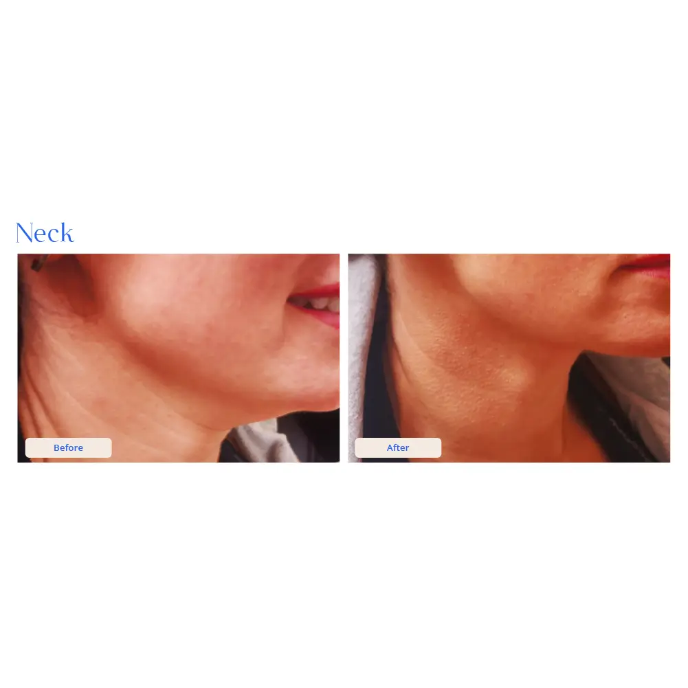 Before and After Result 17